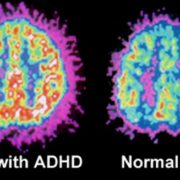 Differences In Brain Structure For Children With A.D.H.D - ADD & ADHD ...